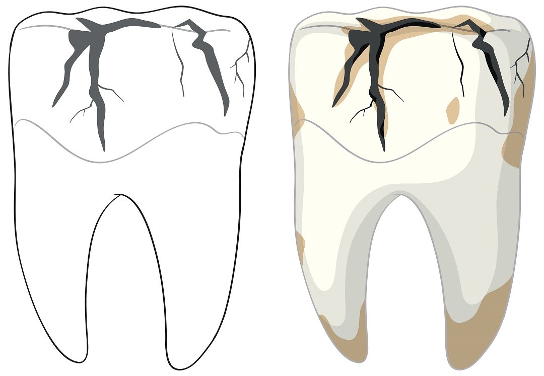 Cracked teeth