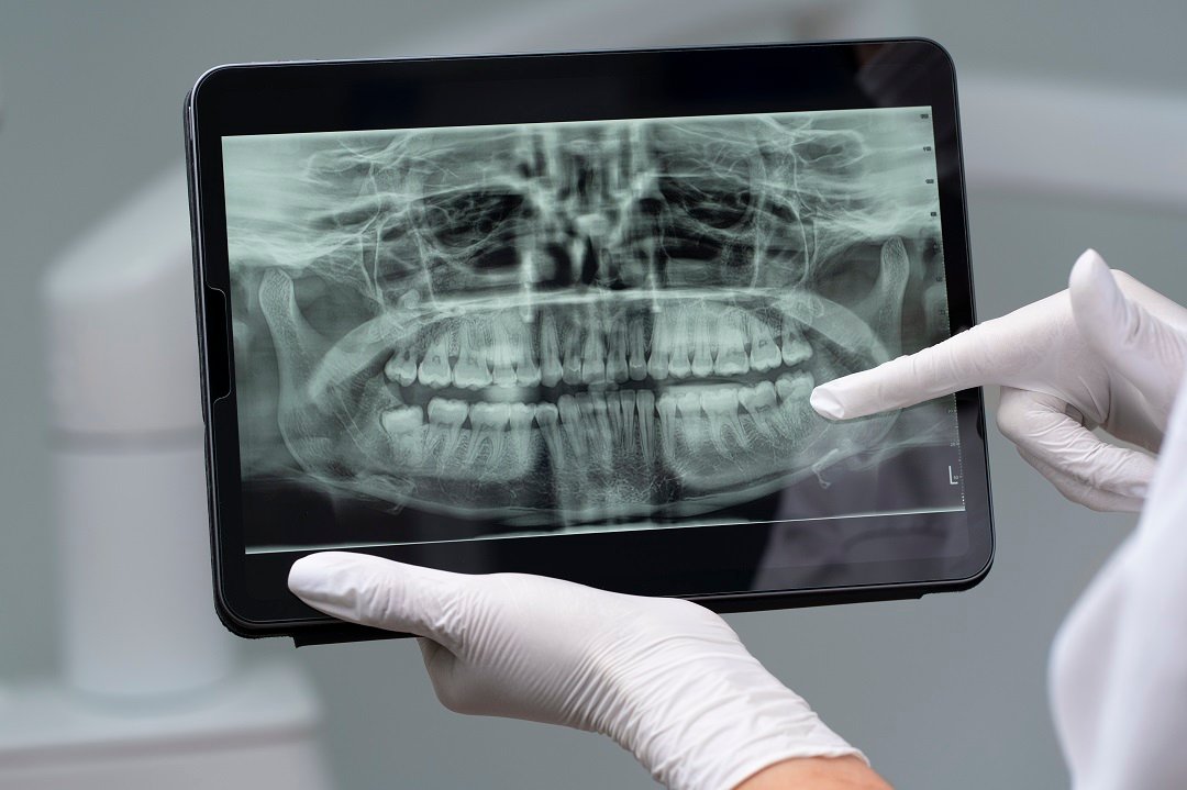 Dental X-Rays